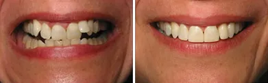 Six Month Smiles