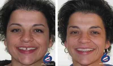 Six Month Smiles